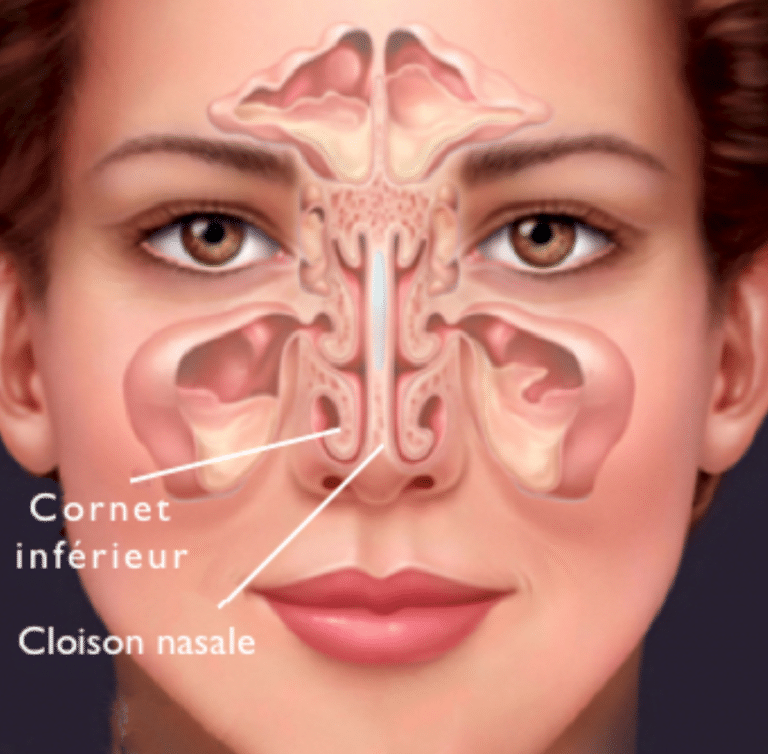 SYNDROME DU NEZ VIDE focus et Rhinoplastie Paris